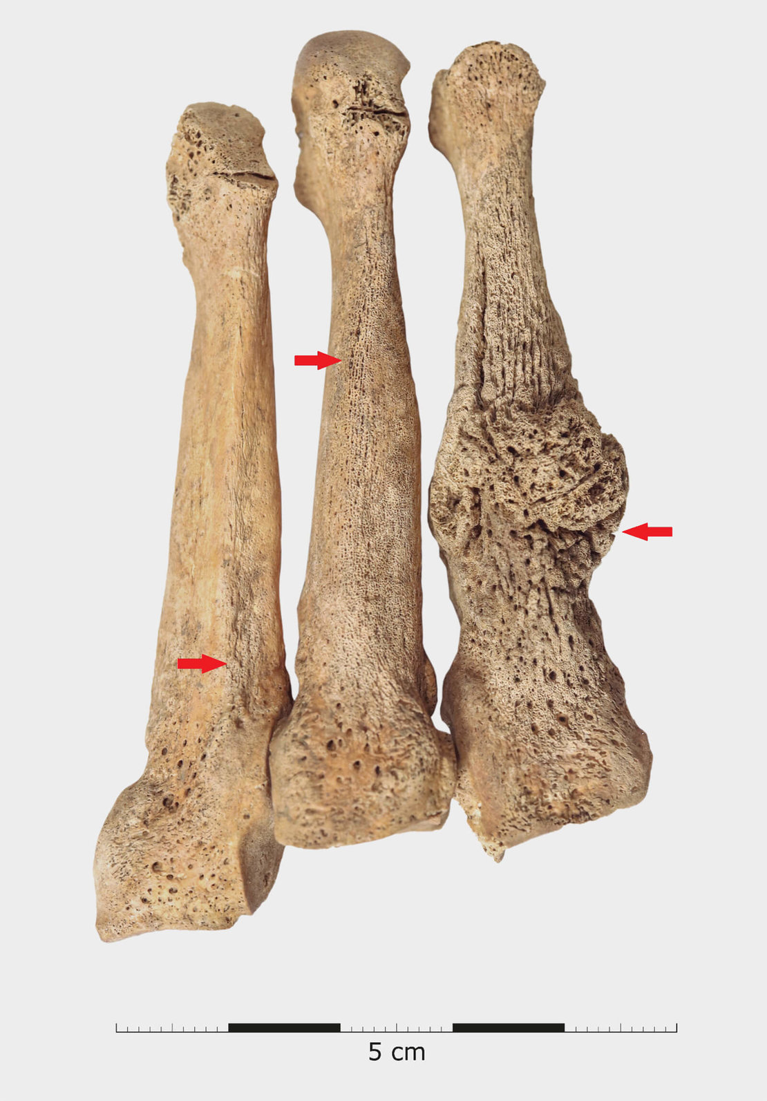 Marschfrakturen am Mittelfußknochen, Foto: Novetus GmbH 