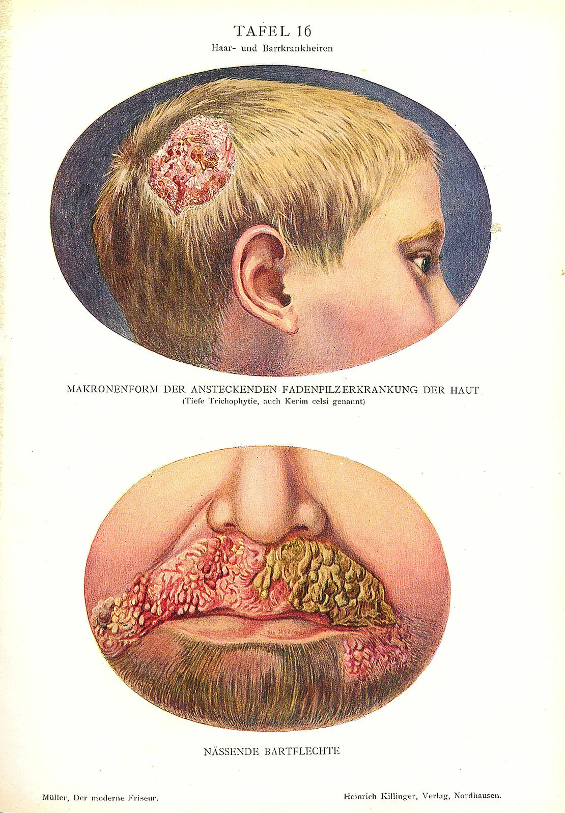 Haarkrankheiten, aus: Ferdinand Müller: Der moderne Friseur, Nordhausen 1926