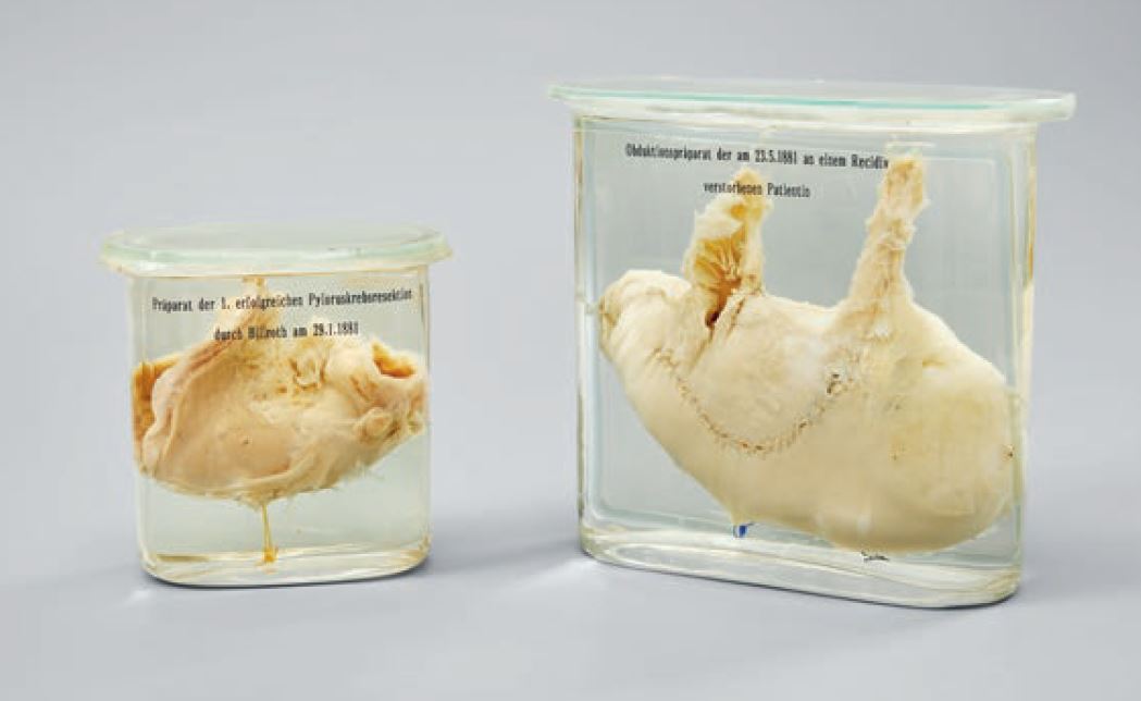 Links der von Billroth operativ entfernte Teil des Magens einer Patientin, die einige Monate nach dem Eingriff verstarb (und ihren Körper der Forschung zur Verfügung stellte, siehe das Magenpräparat rechts), Foto: Bene Croy 